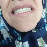 دندان مصنوعی لمینتی طرح لبخند|خدمات آرایشگری و زیبایی|محمدیه-قزوین, |دیوار