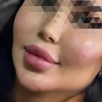 خدمات تخصصی ژل،فیلر،بوتاکس.میکروبلیدینگ ابرو
