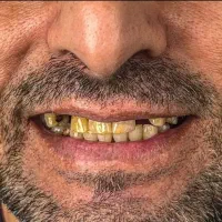 تخفیف ایمپلنت   شرایط ویژه دندانپزشکی|خدمات آرایشگری و زیبایی|اسکو, |دیوار