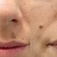 خال برداری و ضایعات پوستی در کلینیک معتبر|خدمات آرایشگری و زیبایی|کرمانشاه, |دیوار