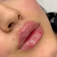 تزریق ژل/فیلربادی/لیفت نخ/ ساکشن