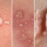 درمان زگیل/تبخال/استاندارد FDA