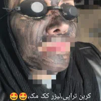 کربن تراپی،پیلینک هالیوودی،وایتینگ