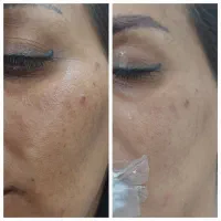لک جوش و منافذ و جای جوش و لیفت و جوانسازی صورت|خدمات آرایشگری و زیبایی|زاهدان, |دیوار