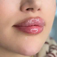 تزریق بوتاکس فیلر ژل پی ار پی مو وصورت