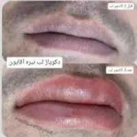مدل جهت برطرف کردن کبودی لب آقایون در کلینیک