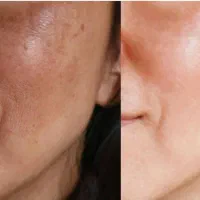 پوتاکس و مزوژل جوانسازی طبیعی بدون نقص