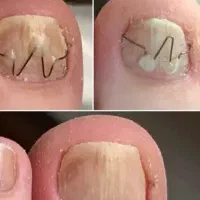 ارتونیل . ارتودنسی ناخن