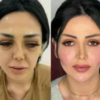 آف بلک فرایدی تزریق ژل بوتاکس فیلر ریمو تتو...|خدمات آرایشگری و زیبایی|علیآباد کتول, |دیوار
