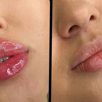 لیفت ابرو با نخ ، ژل لب ، بوتاکس توسط پزشکان متخصص|خدمات آرایشگری و زیبایی|تهران, صادقیه|دیوار