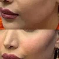 آموزش فیلر و بوتاکس|خدمات زیبایی و سلامت|تهران, شهادت|دیوار