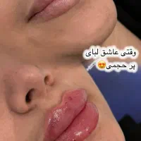 تزریق ژل لب روسی با متد تخصصی روسی و بوتاکس