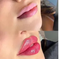کلینیک تزریق ژل و بوتاکس آنزیم فیلر لب پزشک مطب