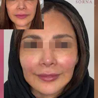 بدون جراحی و برش  صورتت لیفت کن دستگاه اندولیفت