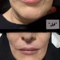 ژل بوتاکس مزوتراپی prp با قیمت استثنائی توسط پزشک|خدمات آرایشگری و زیبایی|اسلام‌شهر, باغ فیض|دیوار
