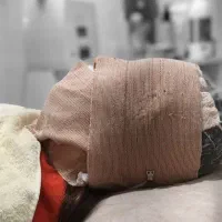 آموزش کربوکسی تراپی