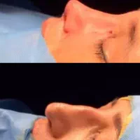 جراحی بینی با تخفیف استثنایی به مدت ۱۰روز