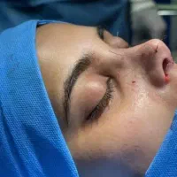 رینوپلاستی ۲۵میلیون|خدمات آرایشگری و زیبایی|قرچک, زیبا شهر|دیوار