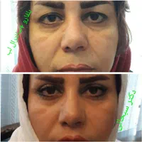 بلفاروپلاستی جراحی پلک لیفت شقیقه ابرو صورت بوتاکس|خدمات آرایشگری و زیبایی|تهران, سلسبیل جنوبی|دیوار