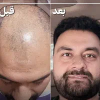 آموزش کاشت مو به شرط استخدام