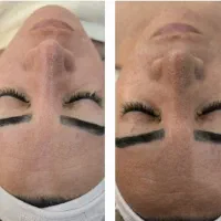 آموزش تخصصی فیشال و پاکسازی پوست|خدمات آموزشی|ارومیه, |دیوار