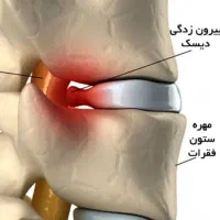 درمان تضمینی دیسک کمر و آرتروز