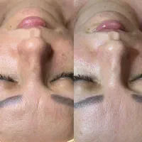 پاکسازی و فیشیال تخصصی پوست