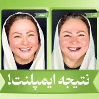 مرکز تخصصی ایمپلنت دیجیتال/اقساط/یکروزه/کاشت دندان