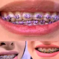 ایمپلنت ارتودنسی لمینت کامپوزیت|خدمات آرایشگری و زیبایی|مشهد, دوست آباد|دیوار