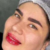 فیبروز میکروبلیدینگ درمجموعه زیبانو