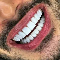 کامپوزیت فکی ۵۹۰۰|خدمات زیبایی و سلامت|تهران, جنتآباد جنوبی|دیوار