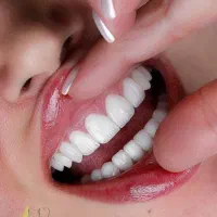 ایمپلنت اقساطی دندانپزشکی لمینیت|خدمات آرایشگری و زیبایی|کیش, |دیوار