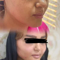 تزریق چربی صورت\فیلرلب/فیلربادی/بوکالفت/غبغب