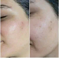 کربن تراپی صورت و بدن|خدمات آرایشگری و زیبایی|فردیس, فردیس|دیوار