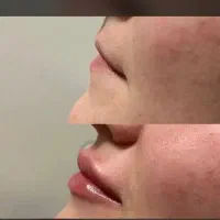 خدمات زیبایی / اصلاح فرم بینی / گودی زیر چشم