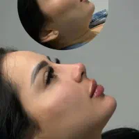 جشنواره زمستانه عمل بینی صفرتاصد فقط ۲۸ تومن