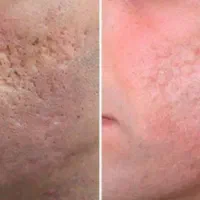لیزر تاتو وخالکوبی ،جای جوش بخیه زخم،اندولیفت|خدمات آرایشگری و زیبایی|فولادشهر, B5|دیوار