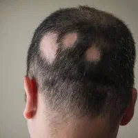 جشنواره prp و مزوتراپی ( آقایان و بانوان)|خدمات آرایشگری و زیبایی|بروجرد, |دیوار