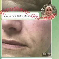 جوانسازی بیومیتیک بدون کار های تهاجمی|آرایشی، بهداشتی، درمانی|تهران, نگین غرب|دیوار