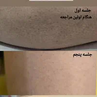 لیزر موهای زائد با جوابدهی تضمینی|خدمات آرایشگری و زیبایی|فولادشهر, B5|دیوار