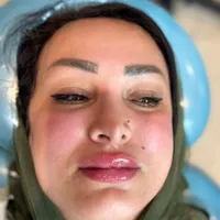 آموزش تزریق ژل به طور کامل