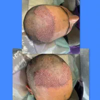 کاشت ریش و مو وابرو طبیعی مشاوره رایگان|خدمات زیبایی و سلامت|کرج, شهرک طالقانی|دیوار