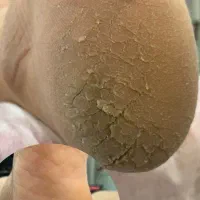 رفع ترک و خشکی های پا