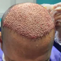 کاشت مو برتر