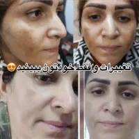 کرم سفیدکننده ضدلک ضدجوش جوانساز دائمی قوی صورت