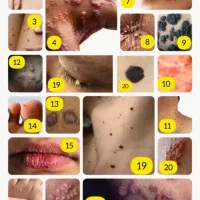 زگیل تناسلی اچ پی وی بدون عمل جراحی و لیزر