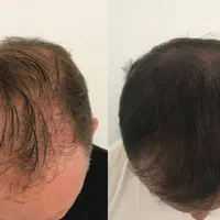 میکرواسکالپ / اسکالپ جایگزین کاشت مو تضمینی|خدمات آرایشگری و زیبایی|مشهد, شهید فرامرز عباسی|دیوار