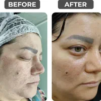 پاکسازی،مزونیدلینگ،برداشتن کک ومک،پیرسینگ+آموزش|خدمات آرایشگری و زیبایی|مشهد, سجاد شهر|دیوار