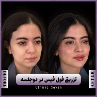 تخفیفات ۵۵٪ دکتر ملائی ،مزو بوتاکس فیلر ژل لب روسی|خدمات آرایشگری و زیبایی|مشهد, کوثر|دیوار