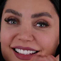 سفید کردن دندان با تخفیف ویژه و فقط با یک جلسه